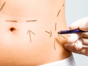 Lipoaspiração é a cirurgia plástica que retira a gordura localizada com uma cânula, conectada a um aspirador para melhorar o contorno corporal.